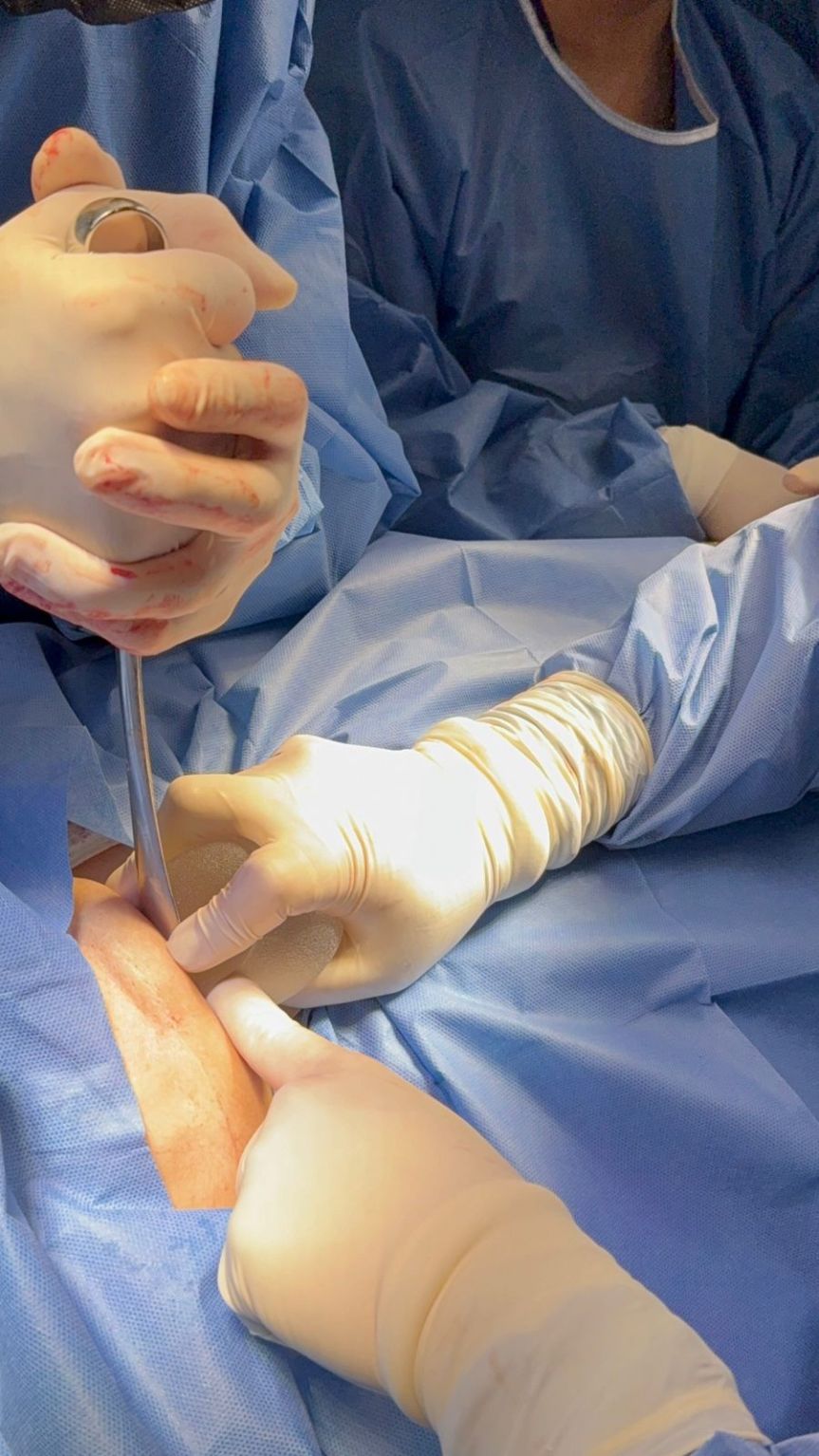 Logran la primera cirugía reconstructiva tras&nbsp;mastectomía.